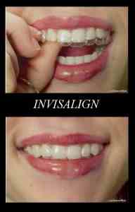 Before-And-After-Invisalign